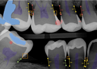 AI xray